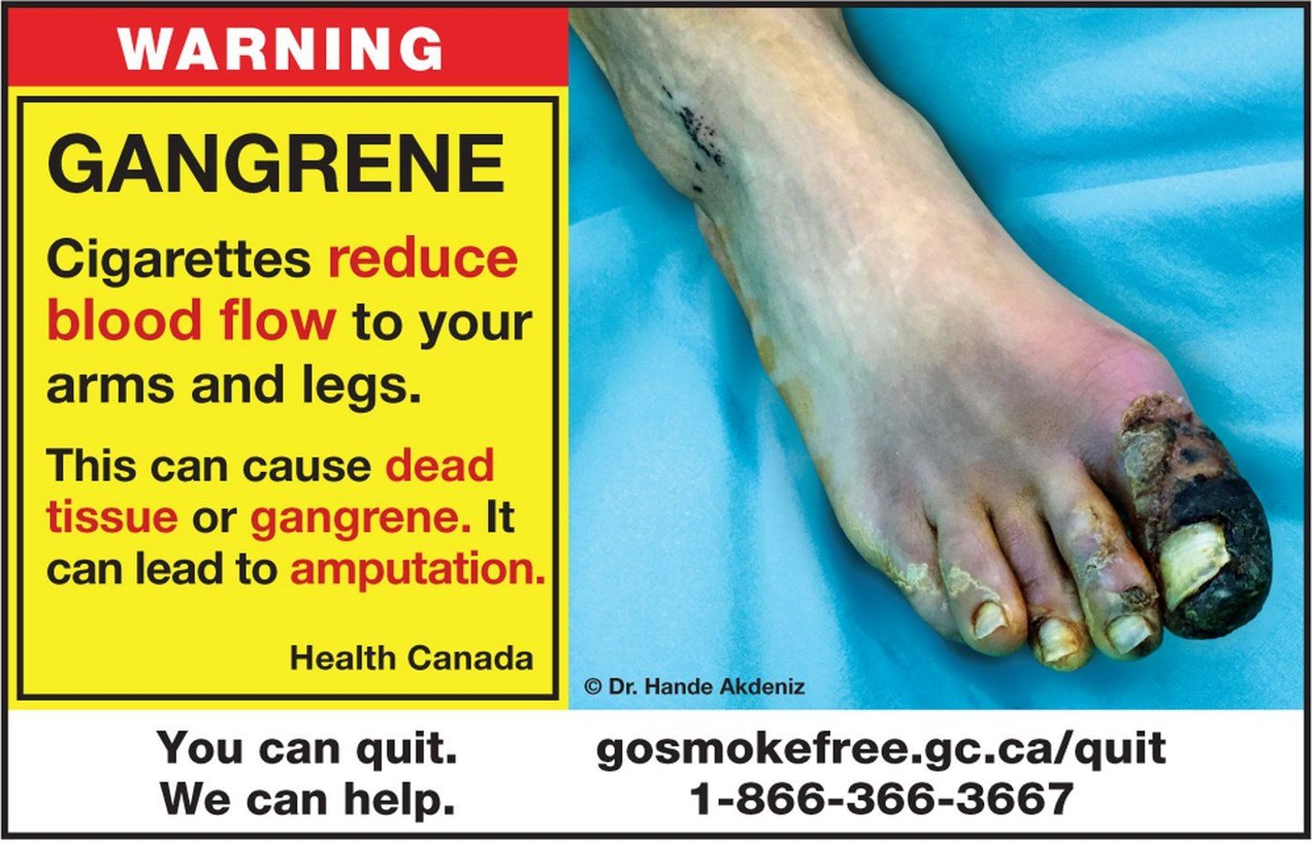 new cigarette packages images with a foot with gangrene